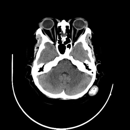 trichilemmal cyst radiology.